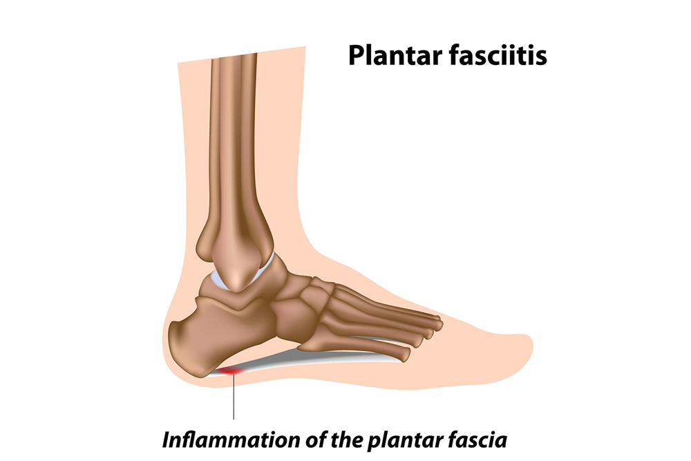 plantar fasciitis foot bone