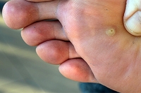 Risk Factors for Plantar Warts