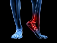 Symptoms of a Heel Spur