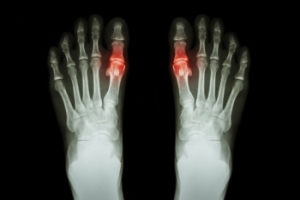 Understanding Gout and the Foods to Avoid