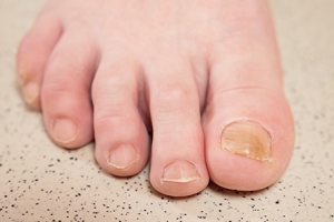 Facts About Fungal Toenails