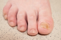Facts About Fungal Toenails