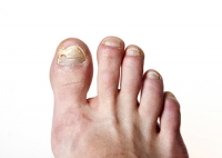 Is Toenail Fungus Contagious?