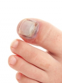 Symptoms of a Broken Toe