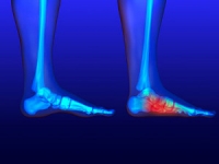 Symptoms and Causes of Flat Feet